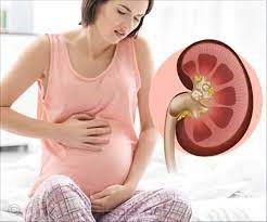 懷孕會增加腎結石的風險