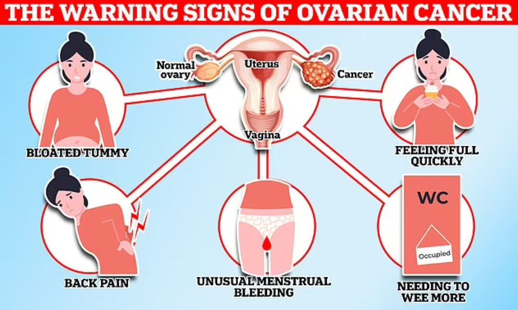 卵巢癌的5個異常警訊